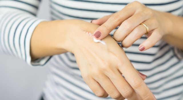 Cicatrices : nos astuces naturelles pour les estomper