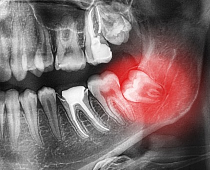 L'imagerie sectionnelle 3D en chirurgie dentaire
