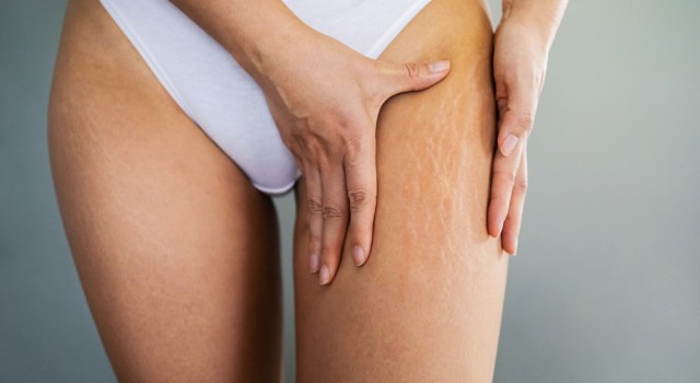 Prévenir les vergetures naturellement, c'est possible !