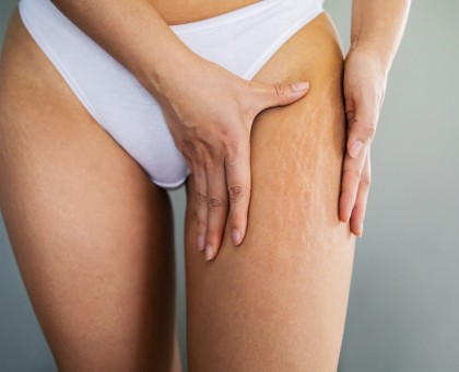 Prévenir les vergetures naturellement, c\'est possible !