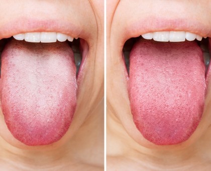 Langue blanche : qu'est-ce que c'est et comment la traiter ?