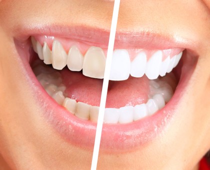 Blanchiment des dents : les idées reçue