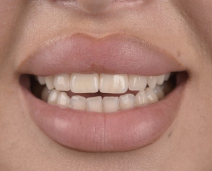 Les facettes dentaires : ce qu'il faut savoir