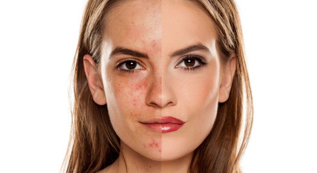 Conseils pour une peau sans acné : adieu boutons et imperfections