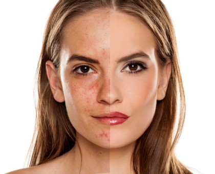 Conseils pour une peau sans acné : adieu boutons et imperfections