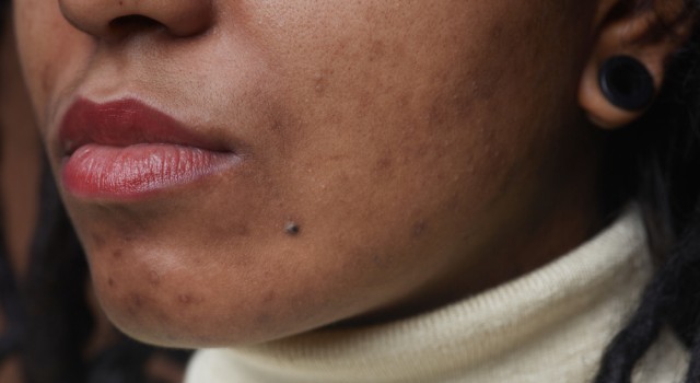 Comment prendre soin de sa peau acnéique naturellement ?