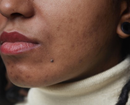 Comment prendre soin de sa peau acnéique naturellement ?