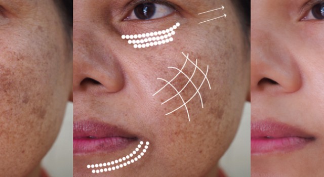 Mélasma : comprendre et traiter les taches pigmentaires