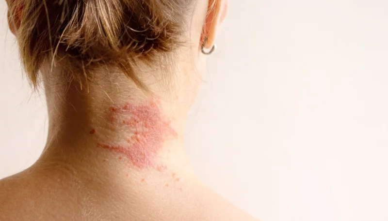 Eczéma : les bons gestes et produits pour apaiser votre peau sensible au quotidien