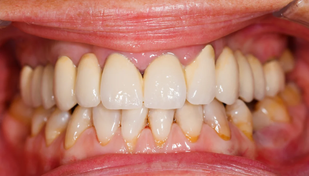 Problèmes dentaires courants : prévention et solutions naturelles