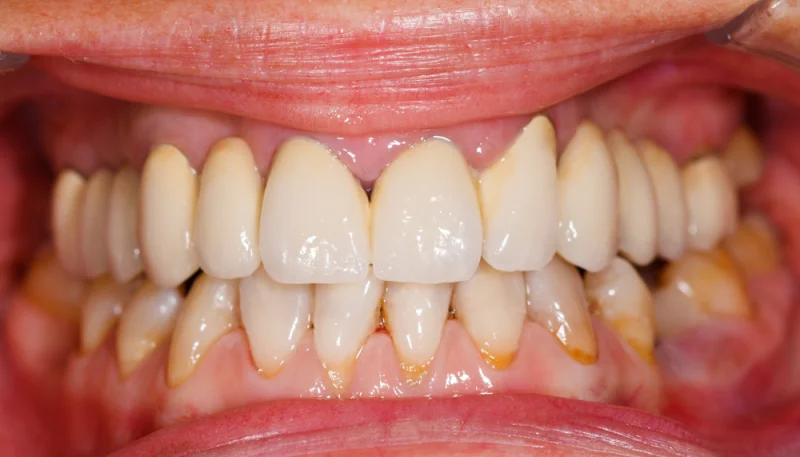 Problèmes dentaires courants : prévention et solutions naturelles