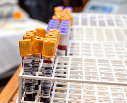 Thyroïde : que dose-t-on dans le bilan sanguin ?