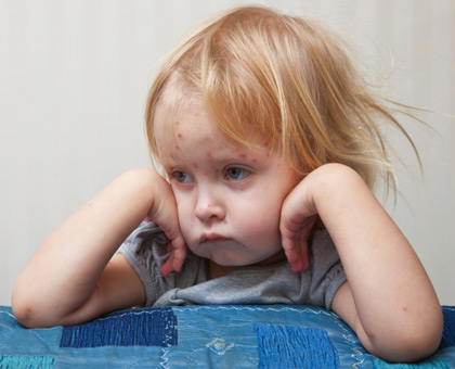 La varicelle fait son retour en France