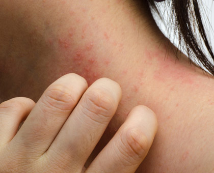 Psoriasis : comment lutter ?