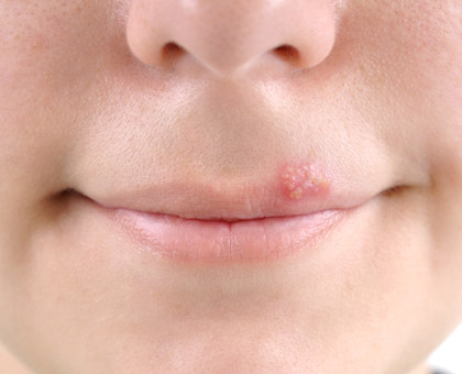 L'herpès labial ou bouton de fièvre
