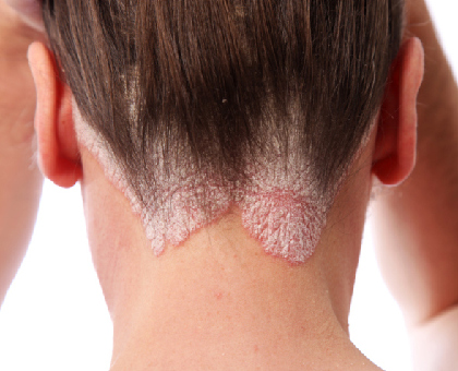 Le psoriasis : symptômes, causes et traitements