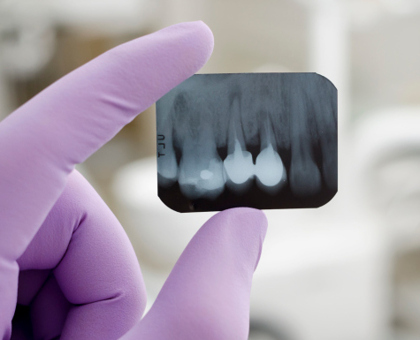 Tout savoir sur l’implant dentaire