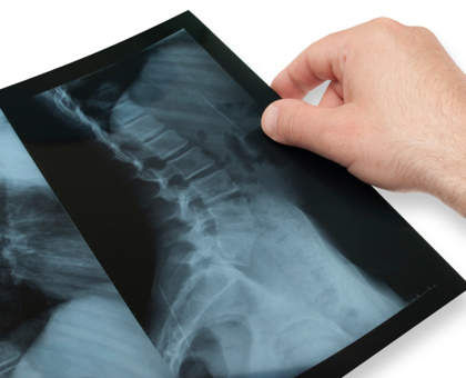 Découverte d’un gène responsable de la scoliose