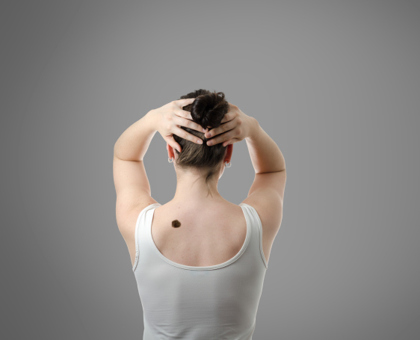 Grains de beauté et cancer de la peau : quand faut-il s'inquiéter ?