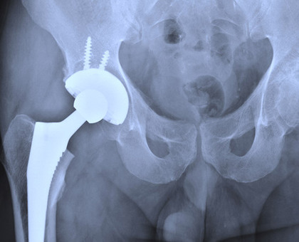 Certaines prothèses de hanche métalliques pourraient être dangereuses pour la santé