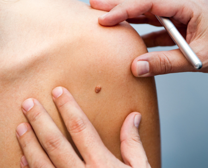 Cancers de la peau : dépistage gratuit le 28 mai dans toute la France