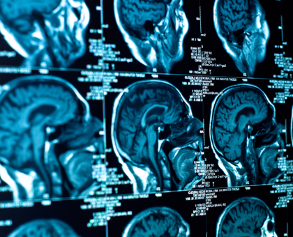 Avancée majeure dans la Maladie de Parkinson : des chercheurs viennent d'en découvrir l'origine