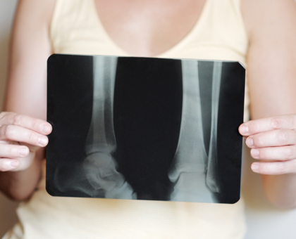 L'ostéoporose : symptômes, causes et traitements