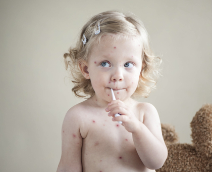 Epidémie de varicelle dans le sud de la France