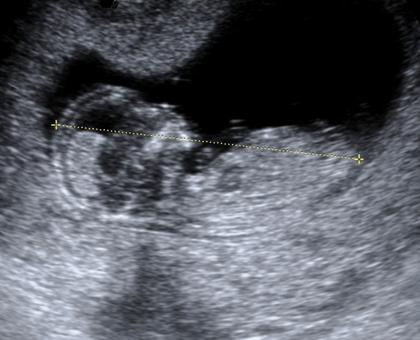 Trisomie 21 : de nouveaux tests pour un dépistage plus efficace
