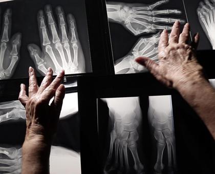 Mardi 2 février sur France 5 : Peut-on soigner les rhumatismes ?