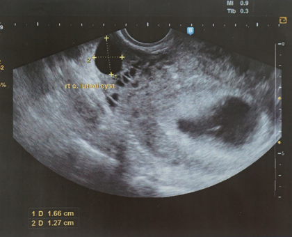 La grossesse - semaine 4