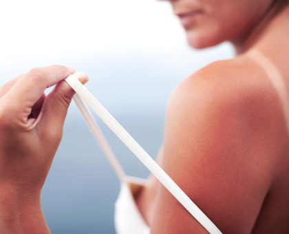 SOS coups de soleil : comment les apaiser naturellement ?