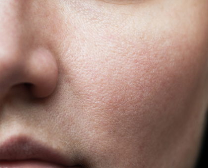 3 astuces naturelles pour resserrer les pores dilatés