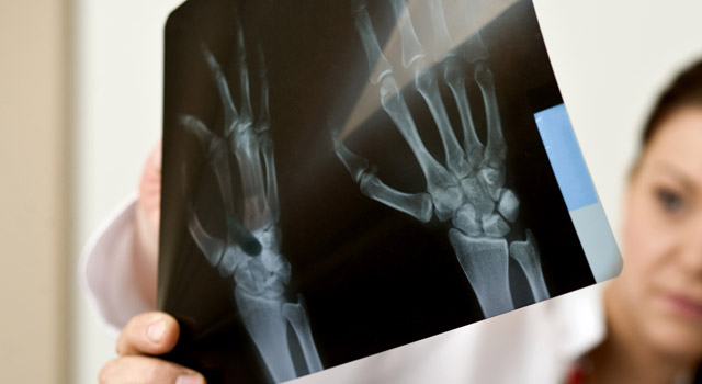 Combattre les rhumatismes grâce à une bonne alimentation