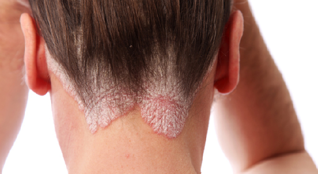 Le psoriasis : symptômes, causes et traitements