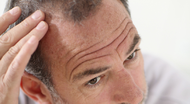 Cancer de la prostate : la calvitie augmente les risques