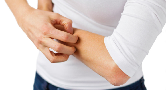 Une urticaire est-elle toujours d’origine allergique ?