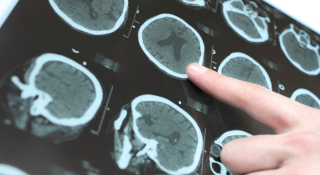 La maladie de Parkinson