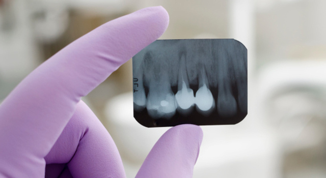Tout savoir sur l’implant dentaire