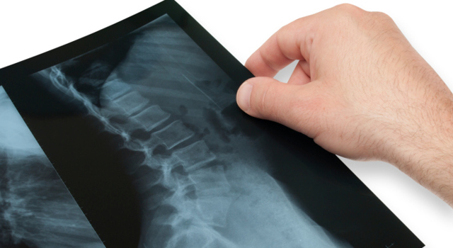 Découverte d’un gène responsable de la scoliose