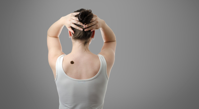Grains de beauté et cancer de la peau : quand faut-il s'inquiéter ?
