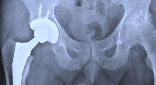 Certaines prothèses de hanche métalliques pourraient être dangereuses pour la santé
