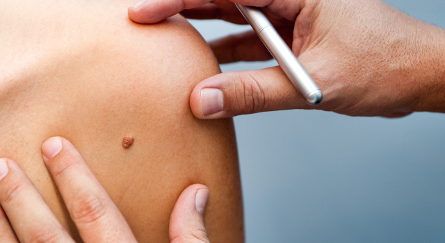 Cancers de la peau : dépistage gratuit le 28 mai dans toute la France