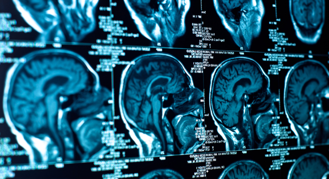 Avancée majeure dans la Maladie de Parkinson : des chercheurs viennent d'en découvrir l'origine