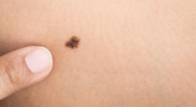 Mélanomes : un nouveau médicament sous forme de virus