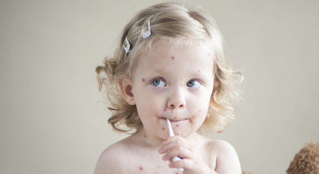 Epidémie de varicelle dans le sud de la France
