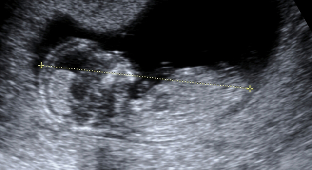 Trisomie 21 : de nouveaux tests pour un dépistage plus efficace