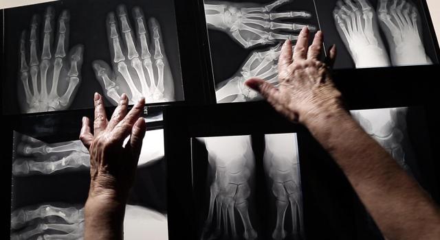 Mardi 2 février sur France 5 : Peut-on soigner les rhumatismes ?