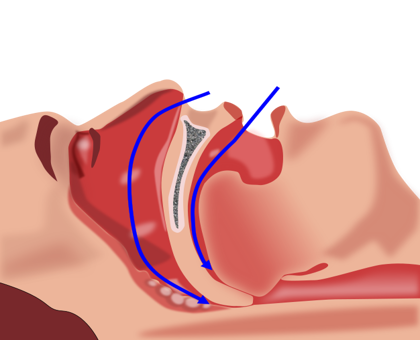 Tout savoir sur l'apnée du sommeil