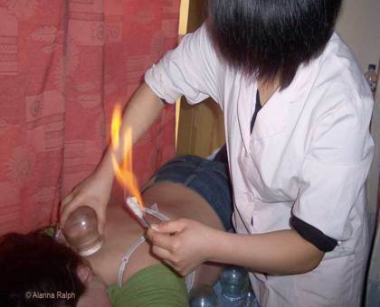 Cupping thérapie - Médecine traditionnelle chinoise à découvrir
